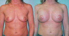 Breast Lift before and after photo