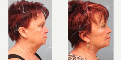 Facelift before and after photo