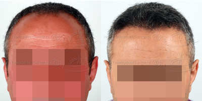 FUE Hair Transplant before and after photo