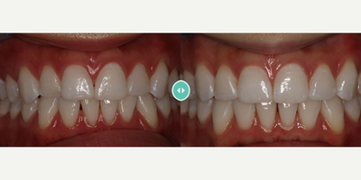 Invisalign before and after photo
