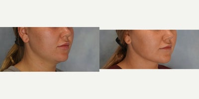 Liposuction before and after photo