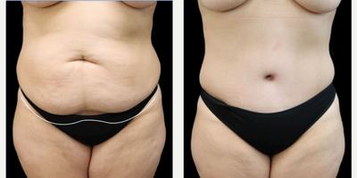 Tummy Tuck before and after photo