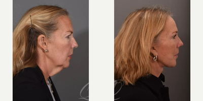 Brow Lift before and after photo