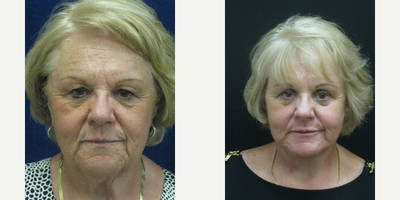 Facelift before and after photo