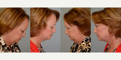 SMAS Facelift before and after photo