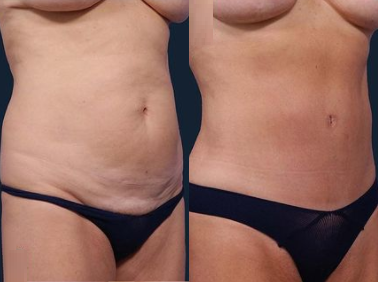 Tummy Tuck before and after photo