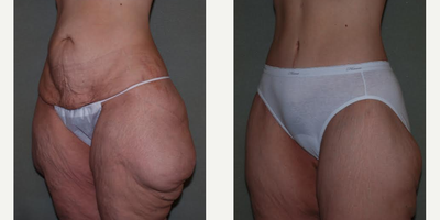 Body Lift before and after photo
