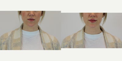 Chin Filler before and after photo