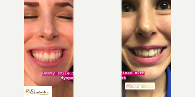 Dysport before and after photo