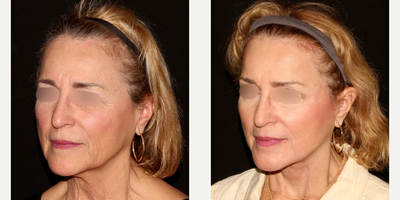 Facelift before and after photo