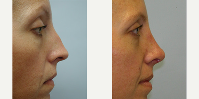 Rhinoplasty before and after photo