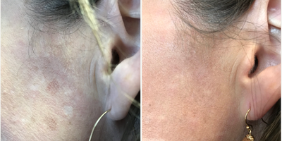 Skin Rejuvenation before and after photo