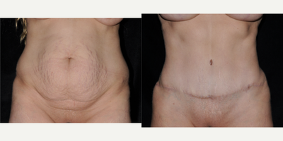 Tummy Tuck before and after photo