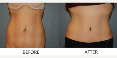 Tummy Tuck before and after photo