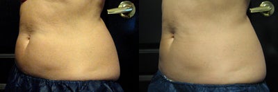 CoolSculpting before and after photo