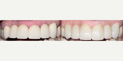 Dental Bridge before and after photo