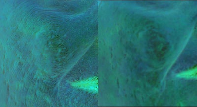 Fraxel Laser before and after photo
