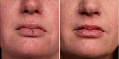 Laser Resurfacing before and after photo