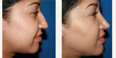 Rhinoplasty before and after photo
