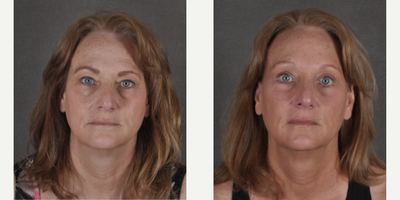 Brow Lift before and after photo