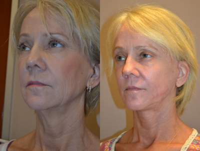 CO2 Laser before and after photo