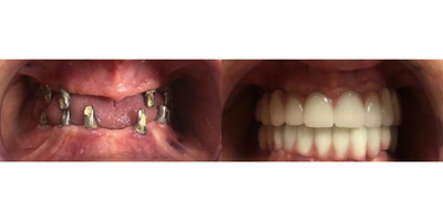 Dental Implants before and after photo