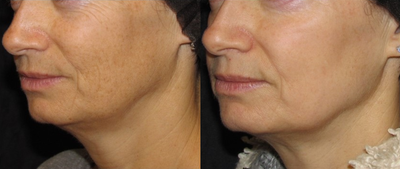Skin Rejuvenation before and after photo