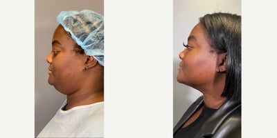 Chin Liposuction before and after photo