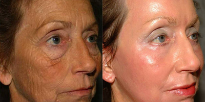 Fraxel Laser before and after photo