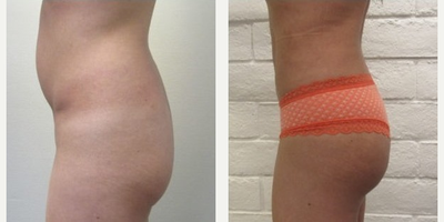 Liposuction before and after photo
