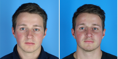 Rhinoplasty before and after photo