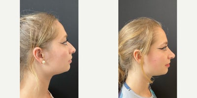 Rhinoplasty before and after photo