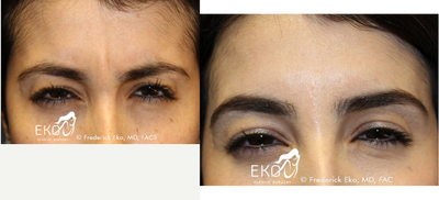 Botox before and after photo