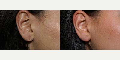 Ear Surgery before and after photo