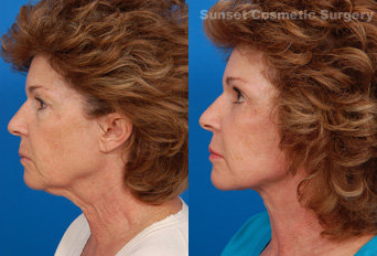 Facelift before and after photo
