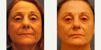 Sculptra before and after photo