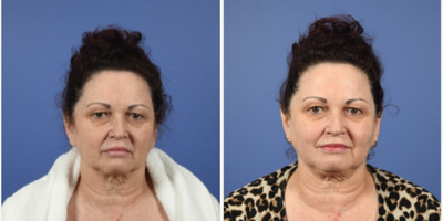 Ultherapy before and after photo
