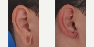 Ear Surgery before and after photo
