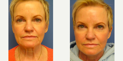 Facelift before and after photo