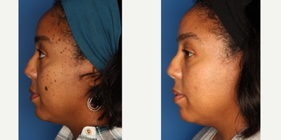 Mole Removal before and after photo