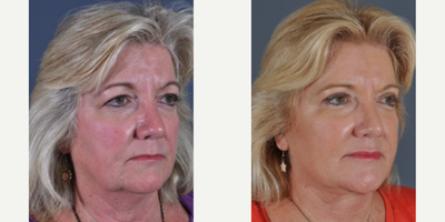 Neck Lift before and after photo
