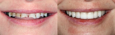 Smile Makeover before and after photo
