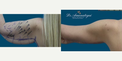 Arm Lift before and after photo