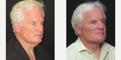 Deep Plane Facelift before and after photo