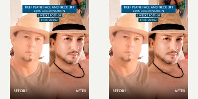 Facelift before and after photo