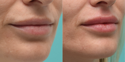 Lip Fillers before and after photo