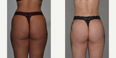 Power-Assisted Liposuction (PAL) before and after photo