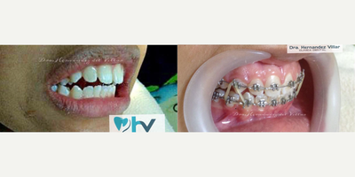 Braces before and after photo