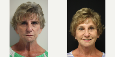 Brow Lift before and after photo