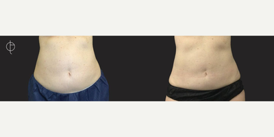 CoolSculpting before and after photo